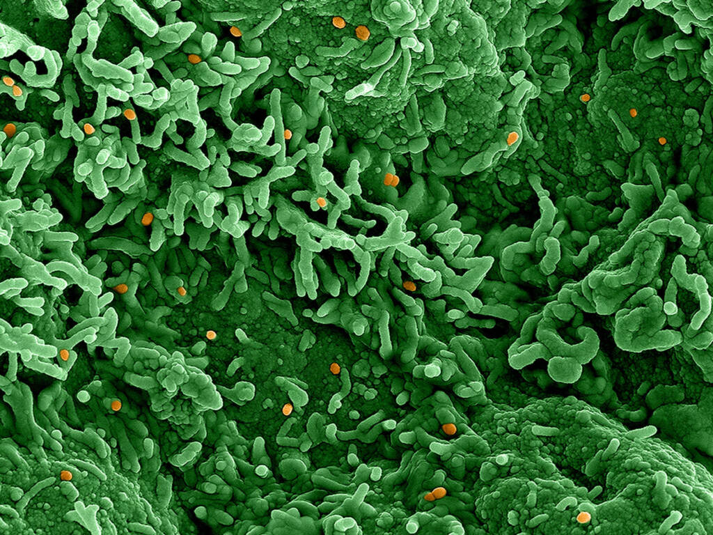 An image from an electron microscope of the monkeypox virus (orange) on infected cells (green). Dots which show the monkeypox virus cells are orange in a sea of green cells that are infected with the virus.