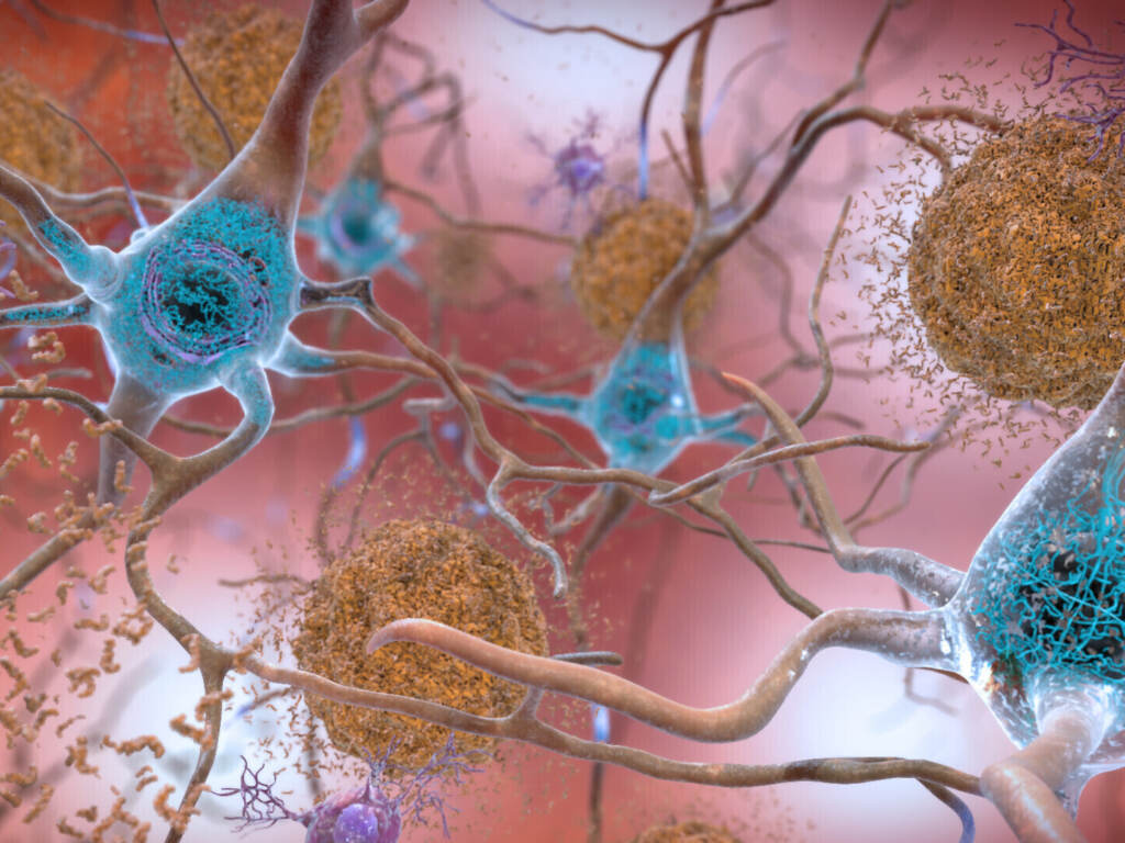 This illustration made available by the National Institute on Aging/National Institutes of Health depicts cells in an Alzheimer’s-affected brain. An experimental drug modestly slowed the brain disease’s progression, researchers reported Tuesday. Cells in an Alzheimer’s affected brain, with abnormal levels of the beta-amyloid protein clumping together to form plaques, brown, that collect between neurons and disrupt cell function