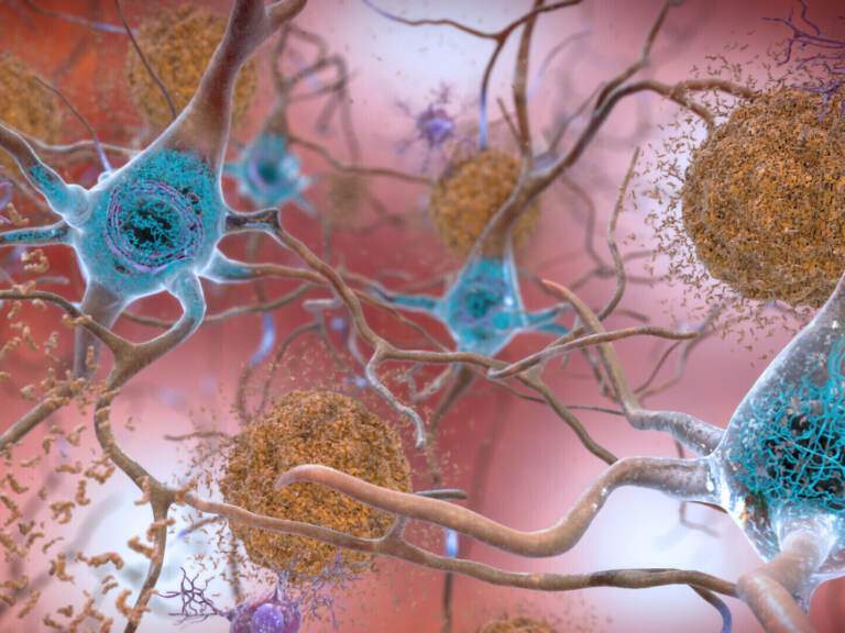 Cells in an Alzheimer’s affected brain, with abnormal levels of the beta-amyloid protein clumping together to form plaques, brown, that collect between neurons and disrupt cell function