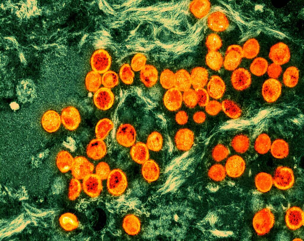 Monkeypox virus An up-close microscopic image of mpox virus particles.