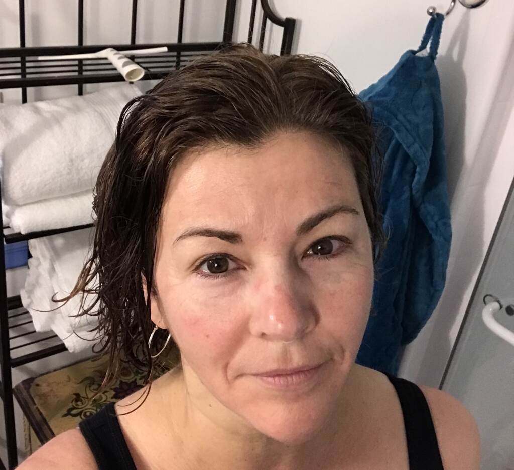 Maiken Scott's skin the day after receiving a microneedling treatment based on stem cells.