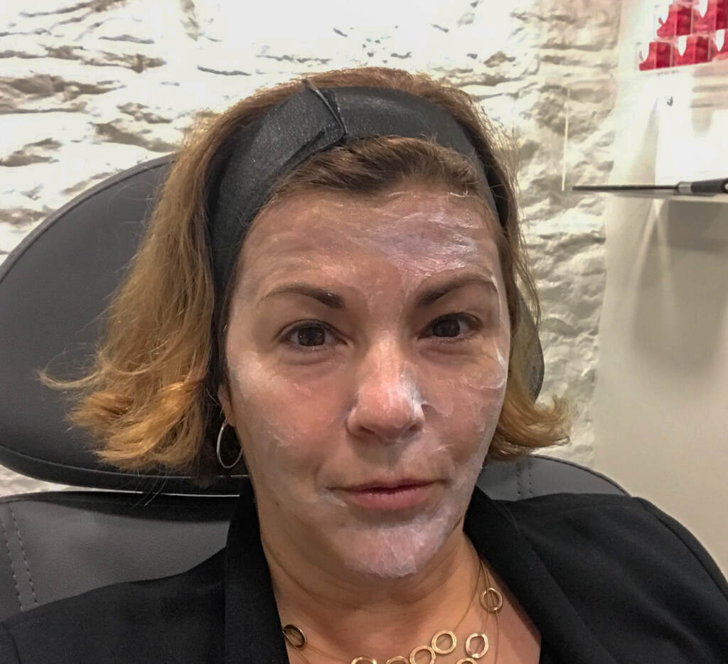 A numbing gel is applied to Maiken Scott's face before receiving a microneedling treatment based on stem cells.