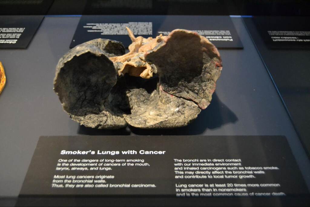 “Smoker’s Lungs with Cancer” at Body Worlds RX at the Da Vinci Science Center in Allentown, Pennsylvania.