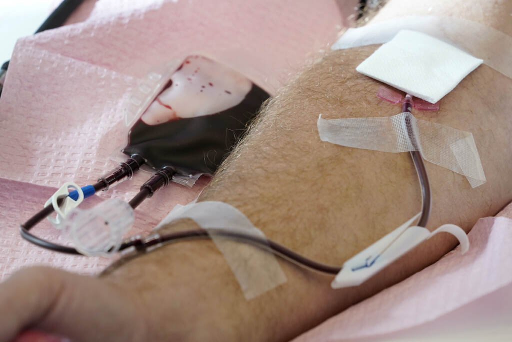 File photo: Tubes direct blood from a donor into a bag in Davenport, Iowa, on Friday, Nov. 11, 2022. The U.S. is moving to ease restrictions on blood donations from gay and bisexual men and other groups that traditionally face higher risks of HIV. The Food and Drug Administration on Friday, Jan. 27, 2023, announced draft guidelines that would do away with the current three-month abstinence requirement for donations from men who have sex with men