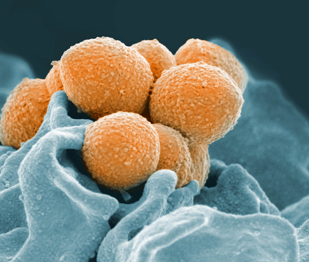 Evolving Strep This handout image provided by the National Institute of Allergy and Infectious Diseases shows an electron microscope image of Group A Streptococcus (orange) during phagocytic interaction with a human neutrophil (blue)