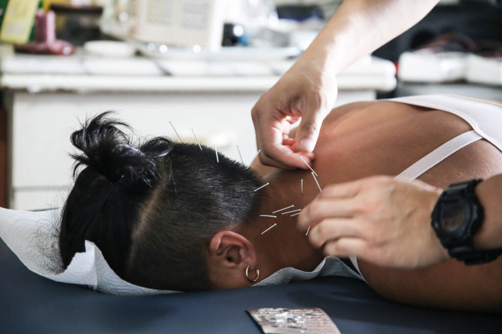 Acupuncturist Toto Cheng performs acupuncture on an athlete. (Lin Tin Nok/WHYY)