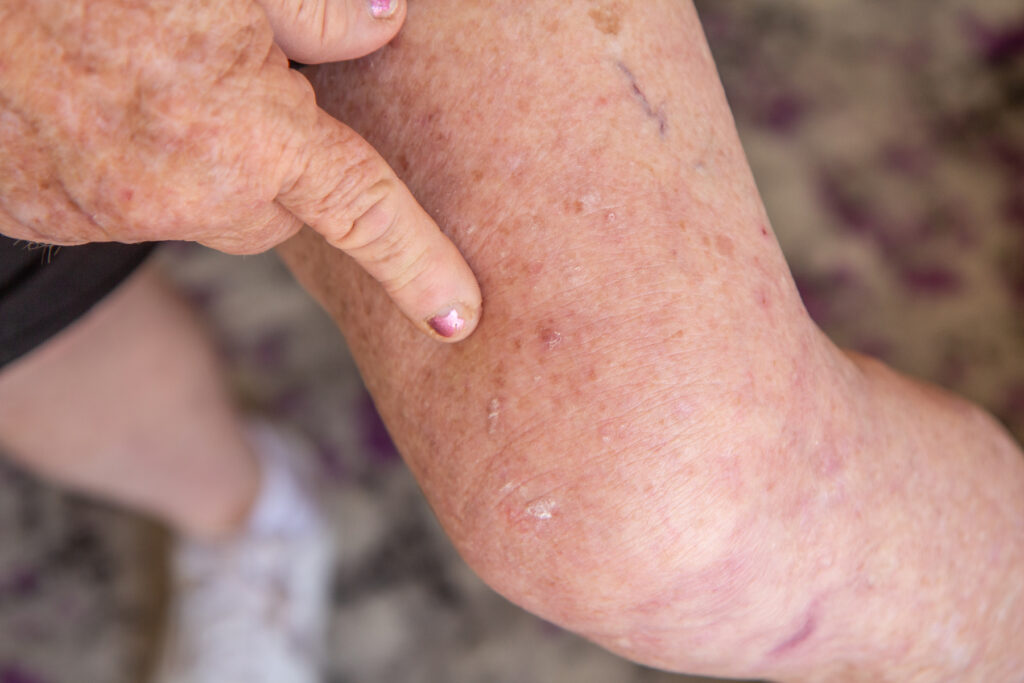 A close-up of Diane Longo pointing towards an itchy sore on her leg.