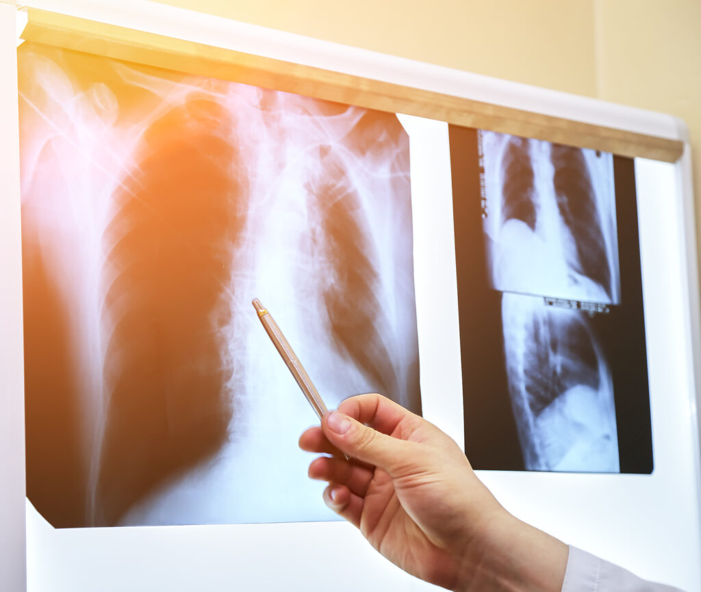 Black And White Medical Chest X-ray. A Picture Of The Lungs In T X-ray of lungs