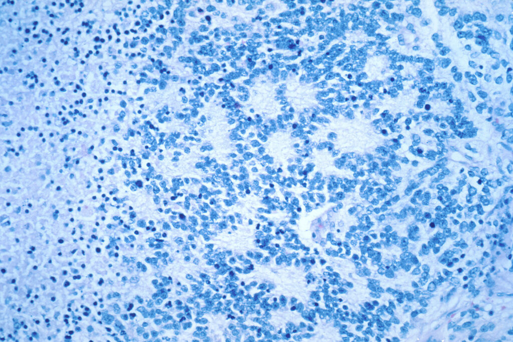 Gene Therapy Cancer a neuroblastoma with rosette formation as seen in a microscope