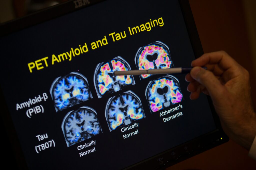 PET-scan-alzheimers A doctor points to PET scan results