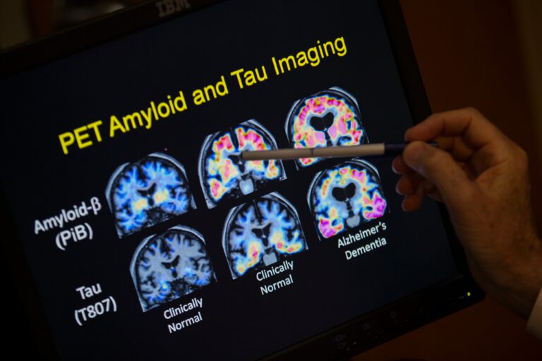 A doctor points to PET scan results