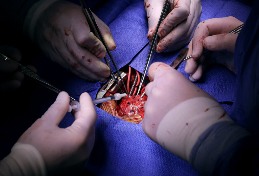 In this Nov. 28, 2016 photo, Dr. Si Pham, bottom left, injects stem cells into Josue Salinas Salgado during open heart surgery at the University of Maryland Medical Center in Baltimore. (AP Photo/Patrick Semansky)