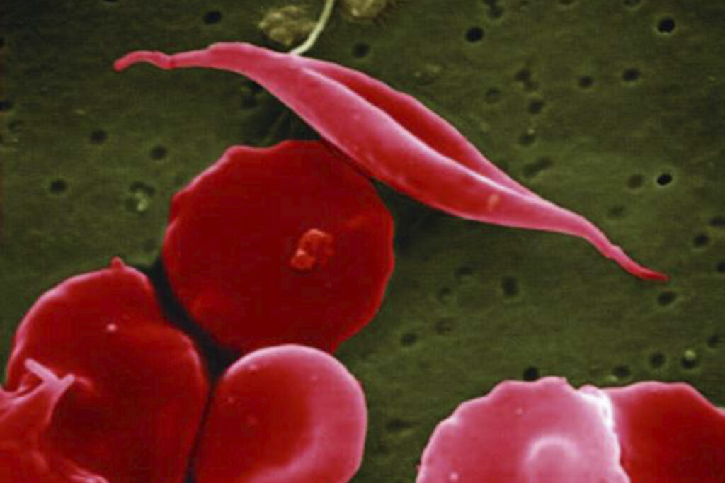 Sickle Cell Therapy Sickle Cell disease
