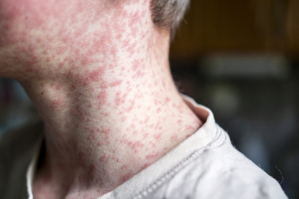 Measles viral disease, human skin covered with measles rash, vaccination concept human skin covered with measles rash