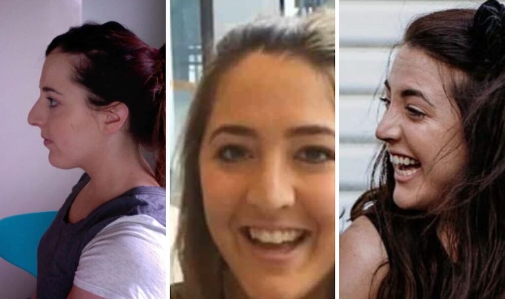 nose-job-after2 After her rhinoplasty, Carla Papas realized the surgery aftermath was more than she could manage. (Courtesy of Carla Papas)