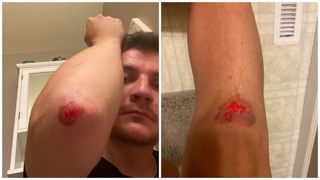cuts on Molina's elbow and knee
