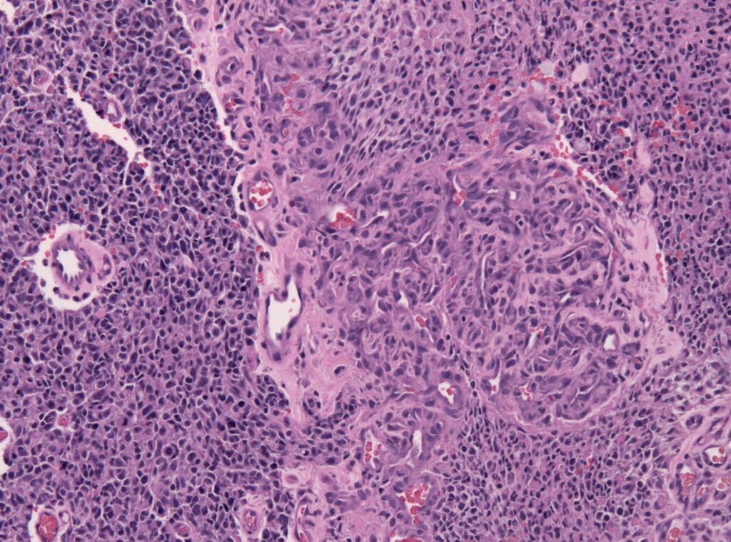 Glioblastoma_endothelial_proliferations Biopsy specimen of a glioblastoma