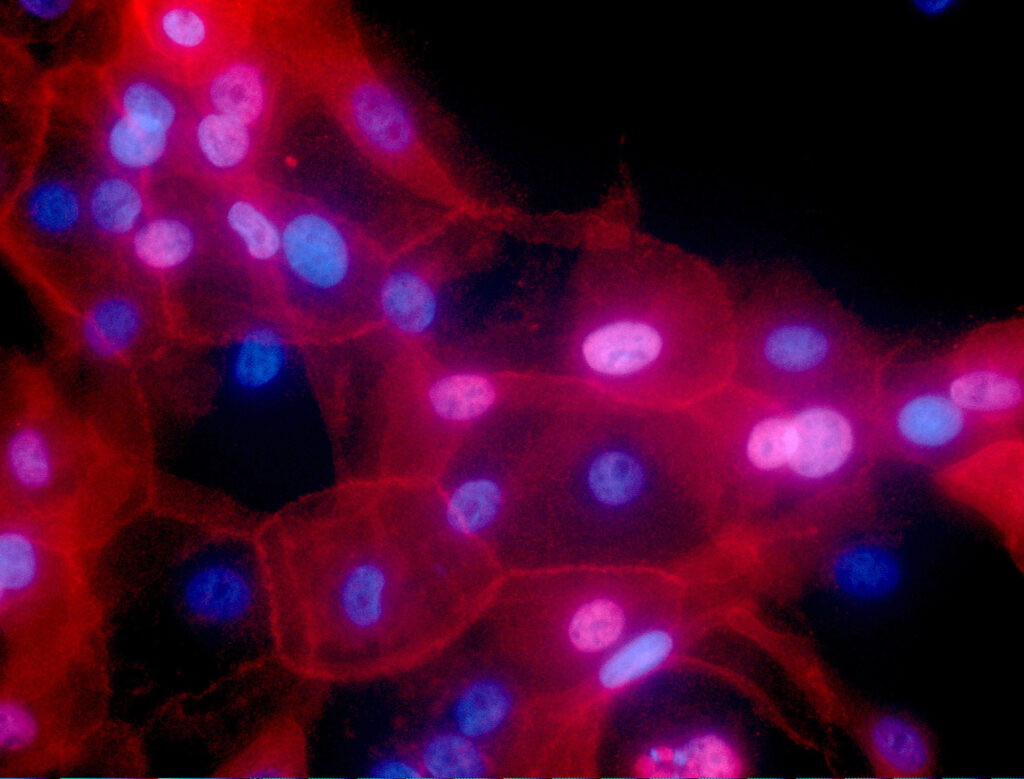 Cancer Treatment a culture of human breast cancer cells