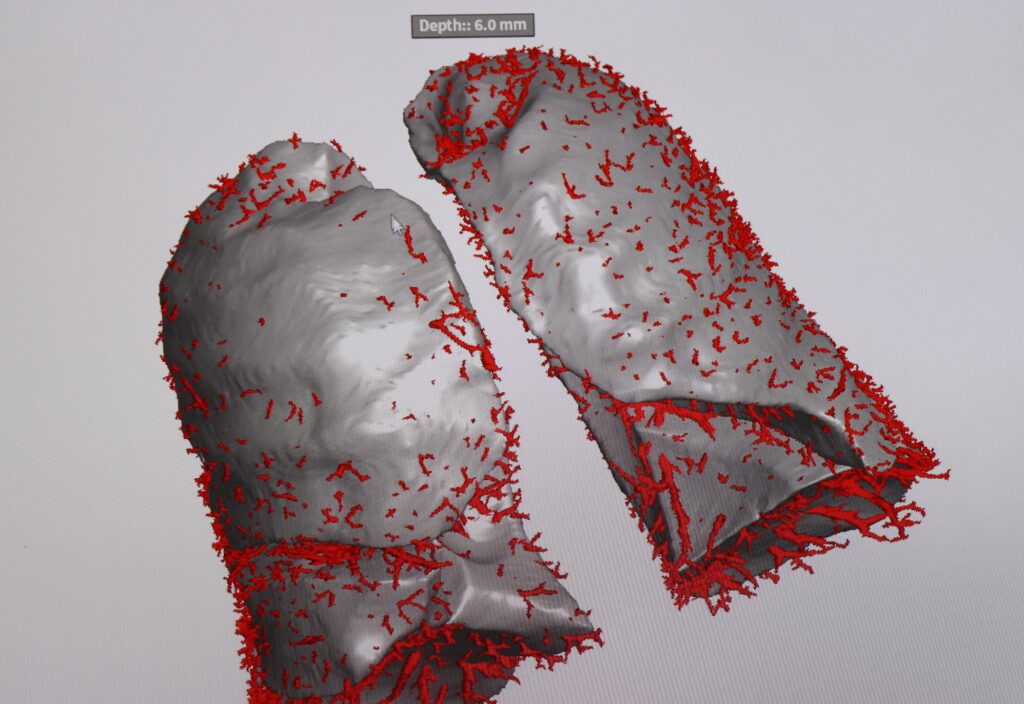 A quantitative imaging program uses artificial intelligence
