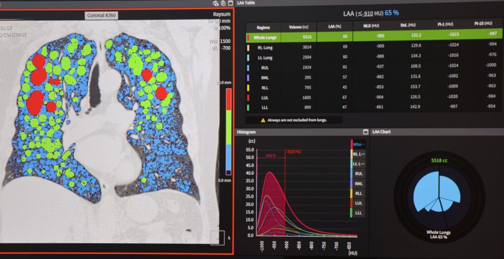 Temple Lung Center uses artificial intelligence software