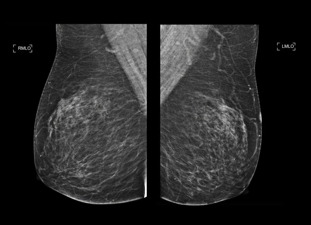 X-ray Digital Mammogram or mammography both side of the breast CC view for diagnonsis Breast cancer in women Mammogram scan showing both sides of the breast