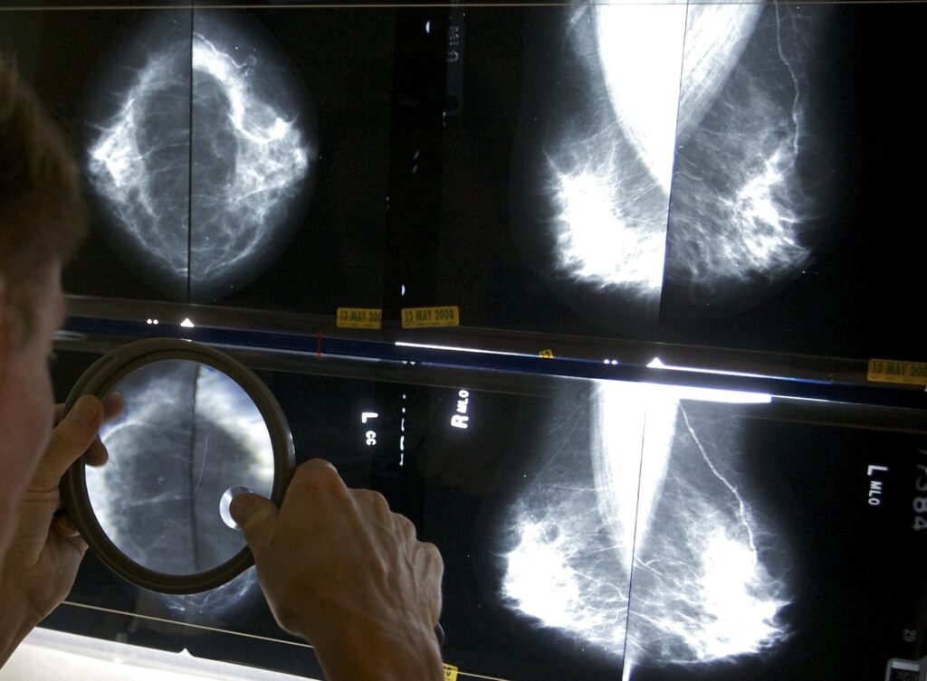 Breast Cancer Treatment A doctor is inspecting images from a mammogram.