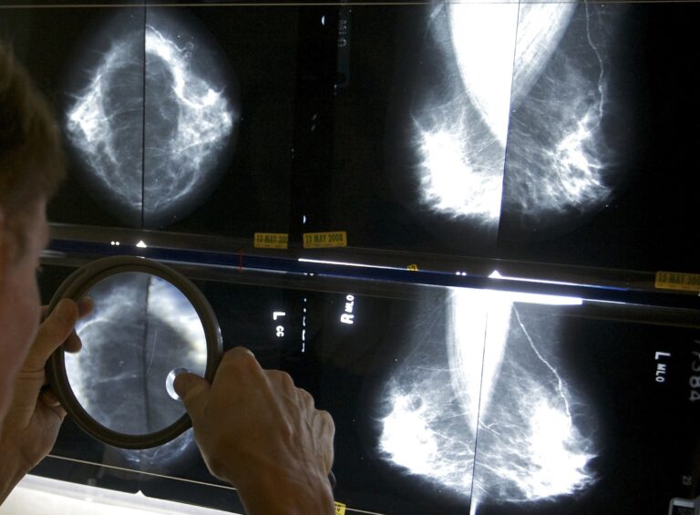 A doctor is inspecting images from a mammogram.